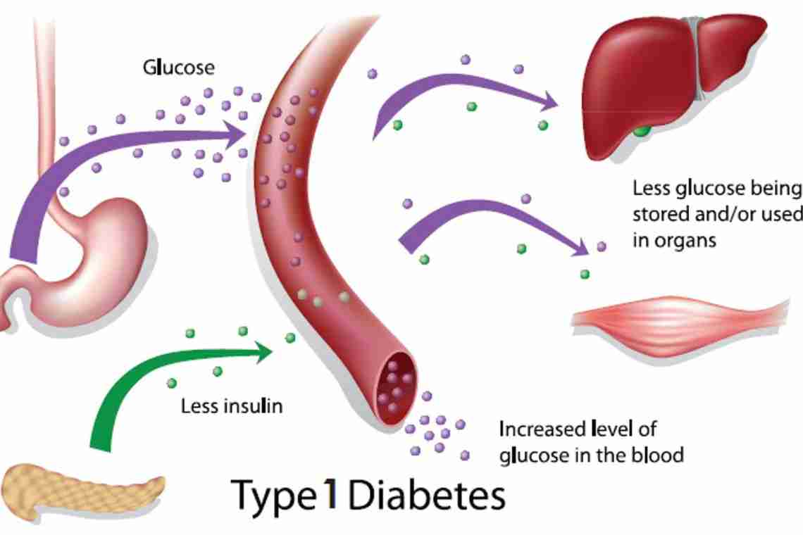 Сахарный диабет, причины возникновения
